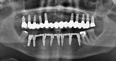 laurent-ohayon-implants-dentaires